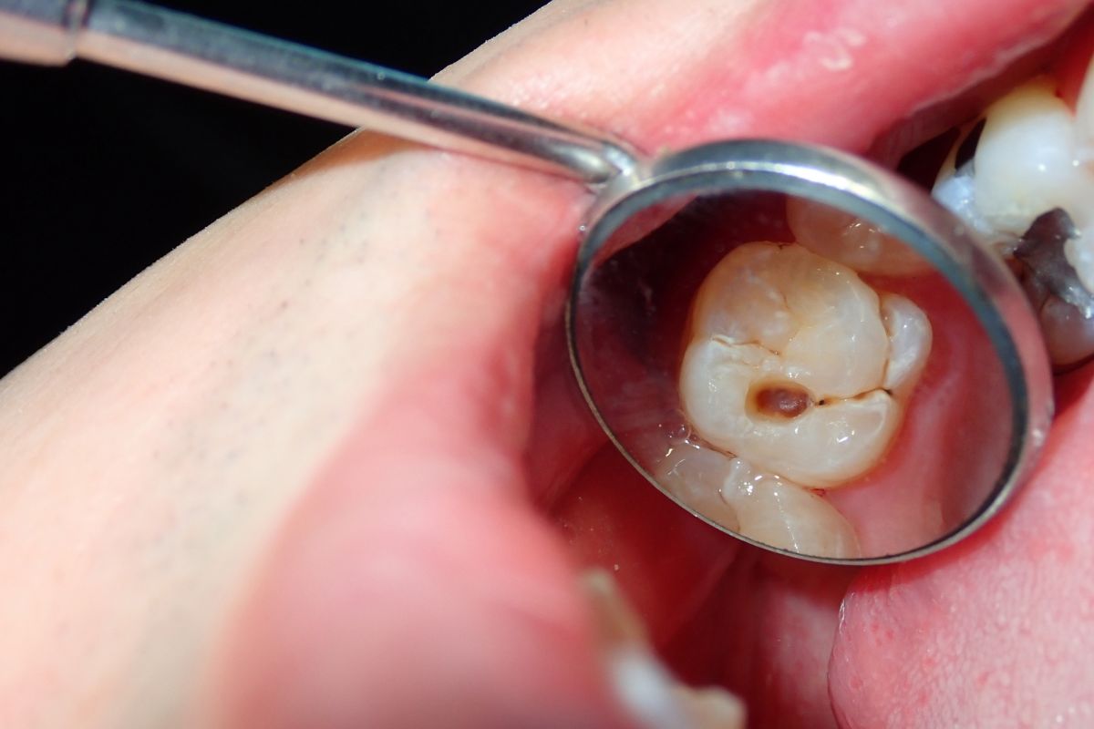 Featured image for “The Importance Of Dental Sealants For Preventing Cavity”