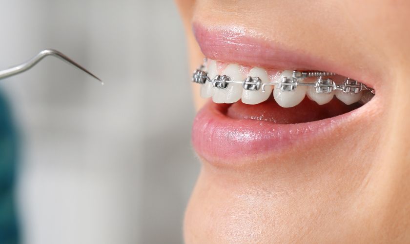 Orthodontic Treatments And Oral Hygiene: Maintaining Dental Health In Wichita Falls