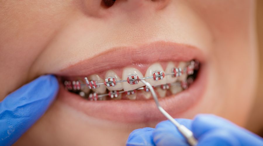 orthodontic treatments