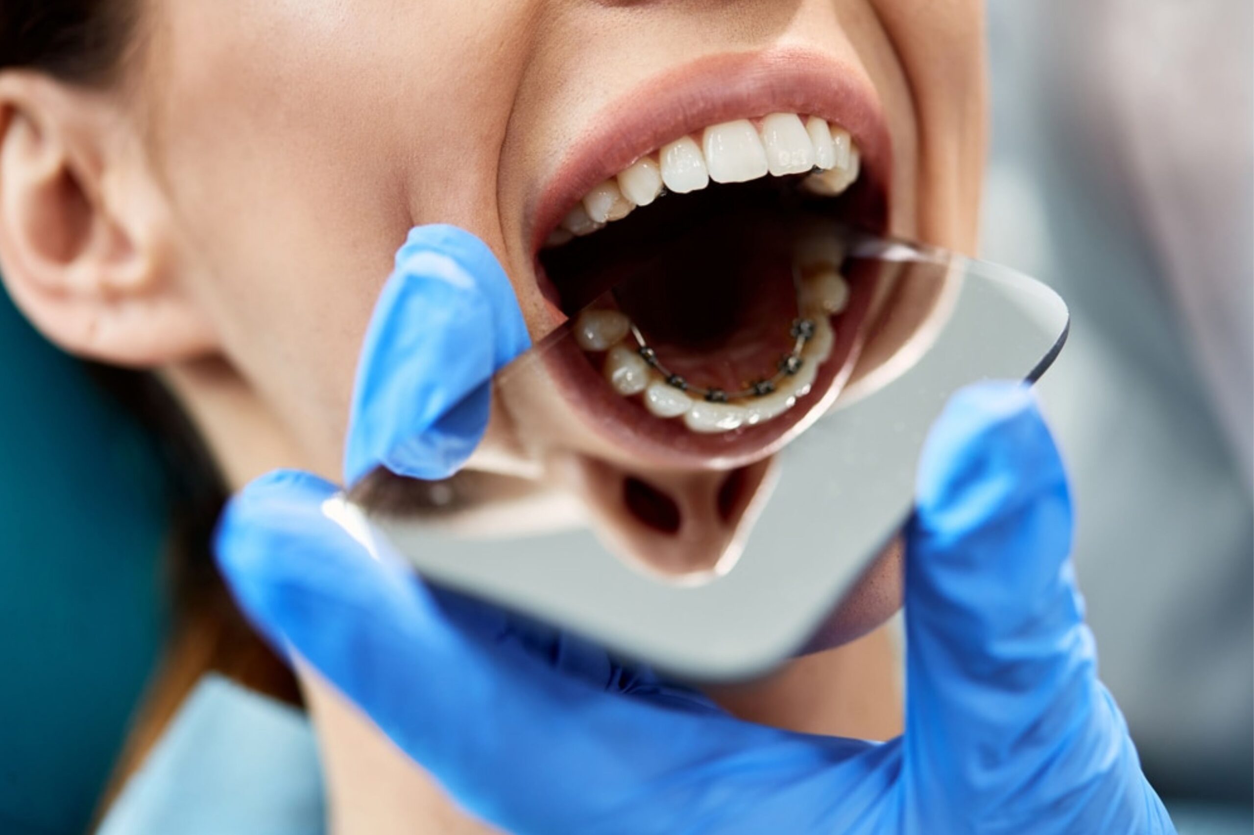 Featured image for “Why Lingual Braces Are a Hit with Wichita Falls Kids”