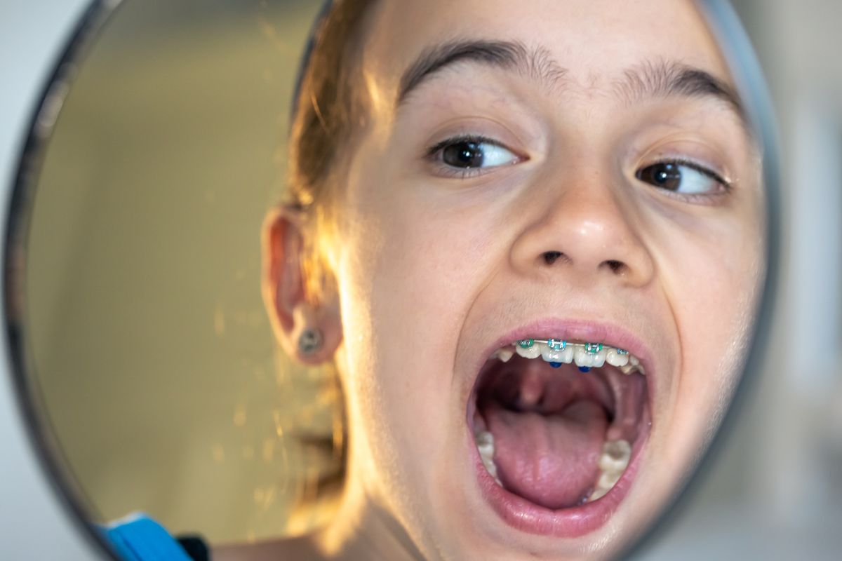 Kid in Wichita Falls, TX, wearing Traditional Braces fixed by an orthodontist and seeing it in the mirror