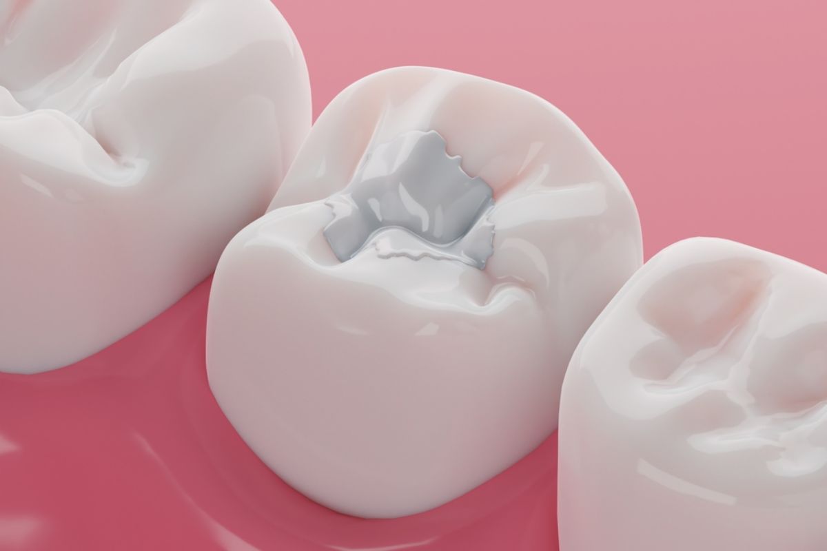 Featured image for “Do Sealants Really Reduce Cavities in Kids?”