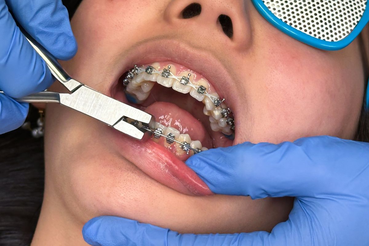 Featured image for “How Often Will My Child Need Orthodontic Adjustments?”