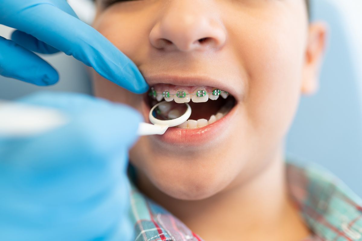 Featured image for “How Does Teeth Grinding Affect Orthodontic Treatment Progress for Kids?”