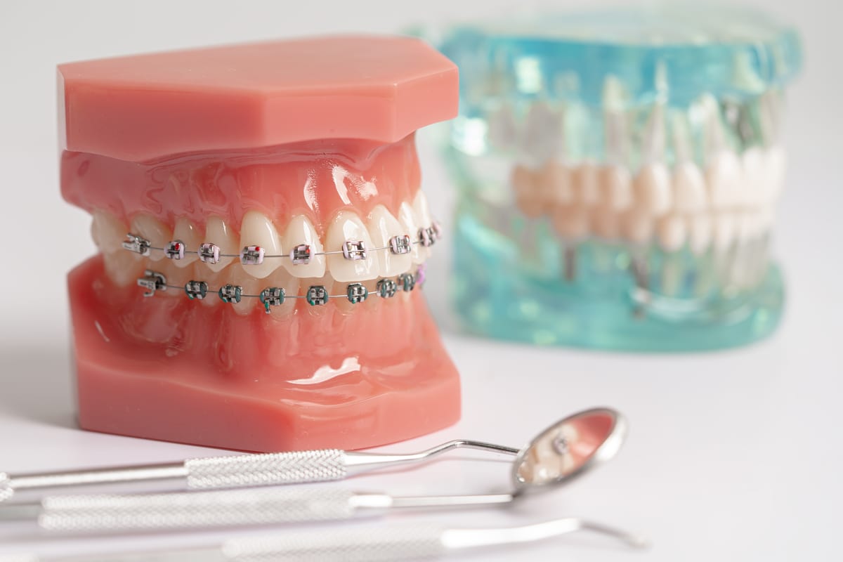 Featured image for “What to Expect After Braces: Your Complete Recovery Guide”