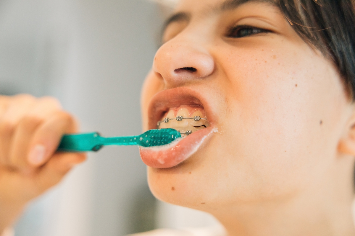 Child brushing teeth with braces – how long kids typically need braces